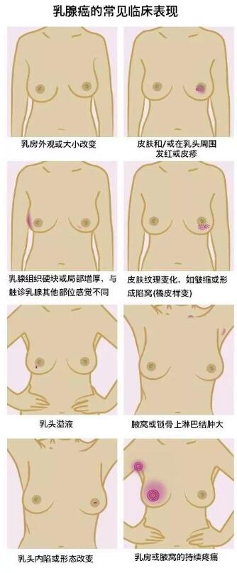 乳腺的自我检查方法图解