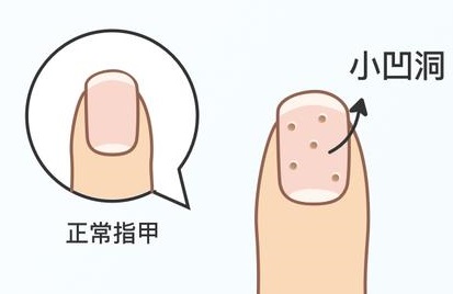 左手大拇指指甲凹陷是怎么回事