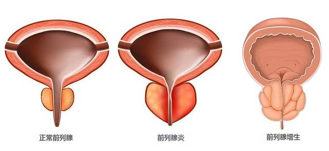 前列腺有什么生理作用是什么