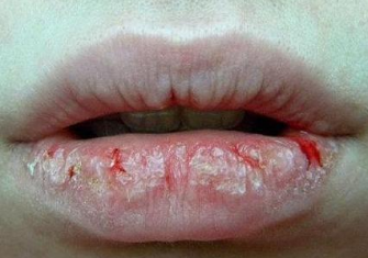 嘴角裂口是什么原因怎么办