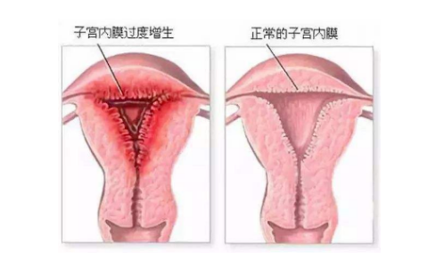 子宫内膜厚是什么原因引起的,要怎么治疗