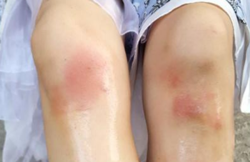 妹子们膝盖上有淤青，是啪啪导致的吗？