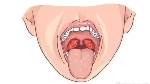 喉咙发炎肿痛怎么办,吞咽疼痛有异物感