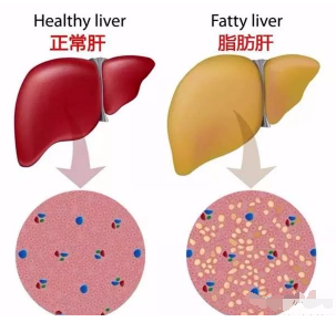 吃什么食物可以去除脂肪肝