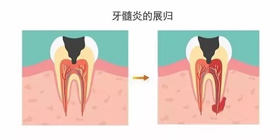 牙髓炎怎么治疗要多久能好
